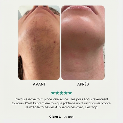 EpilPro - Épilateur visage